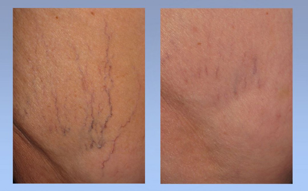 Before After Spider Vein Miller Vein | Miller Vein