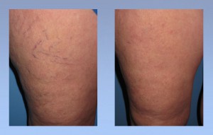 Before After Spider Veins Miller Vein