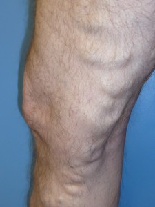 Before Varicose Vein Miller Vein