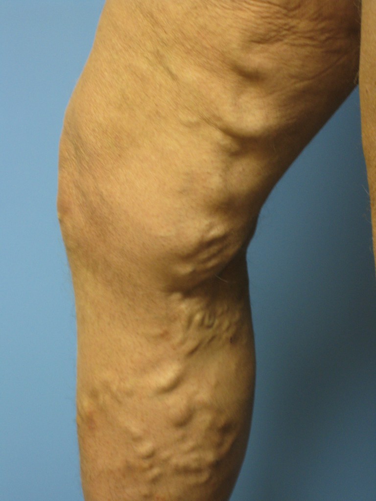 Before Varicose Veins Miller Vein