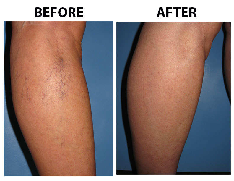 Miller Vein Spider Veins Before and After Pictures 2