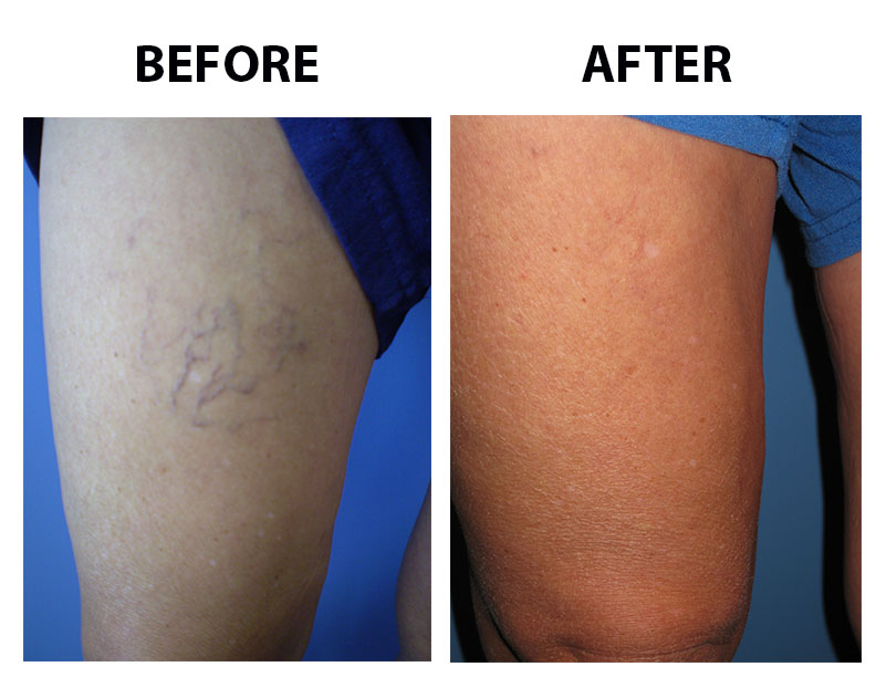 Spider Veins Before and After Pictures