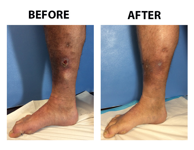 Venous Ulcer Before And After