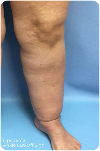 Lipedema | Ankle Cut-off Sign