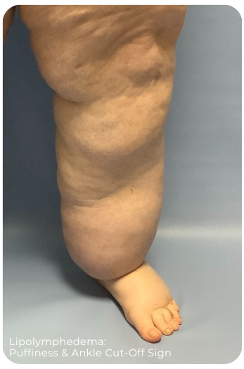 Lipolympedema | Puffiness and Ankle Cut-off