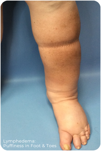 Secondary Lymphedema | Puffy foot and toes